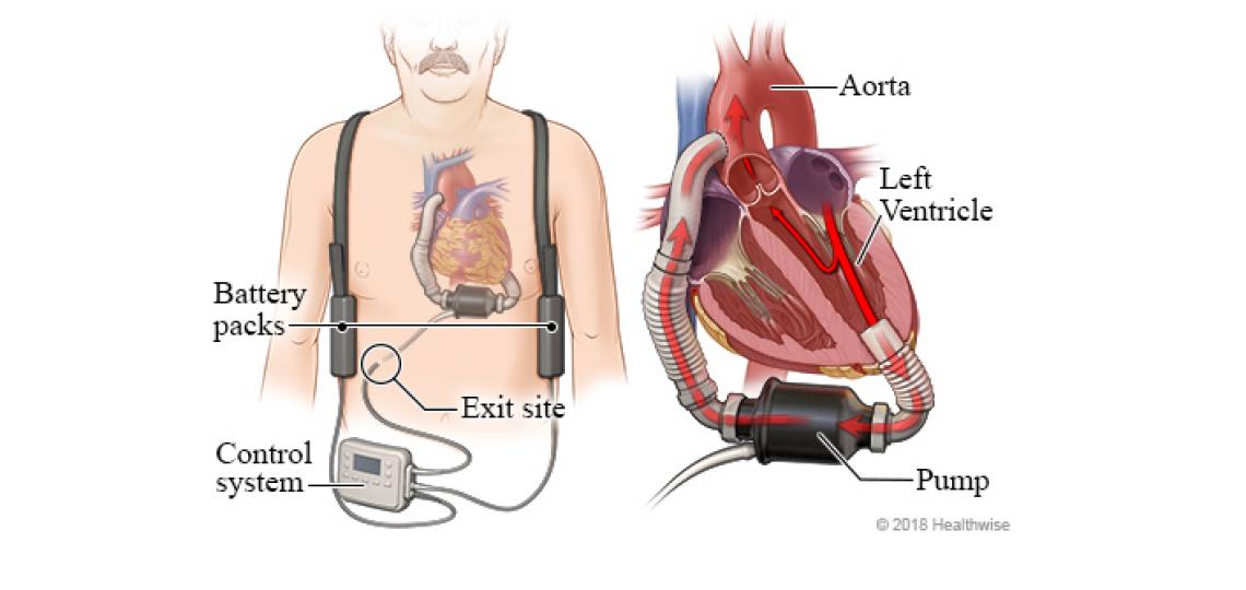 Ventricular assist device