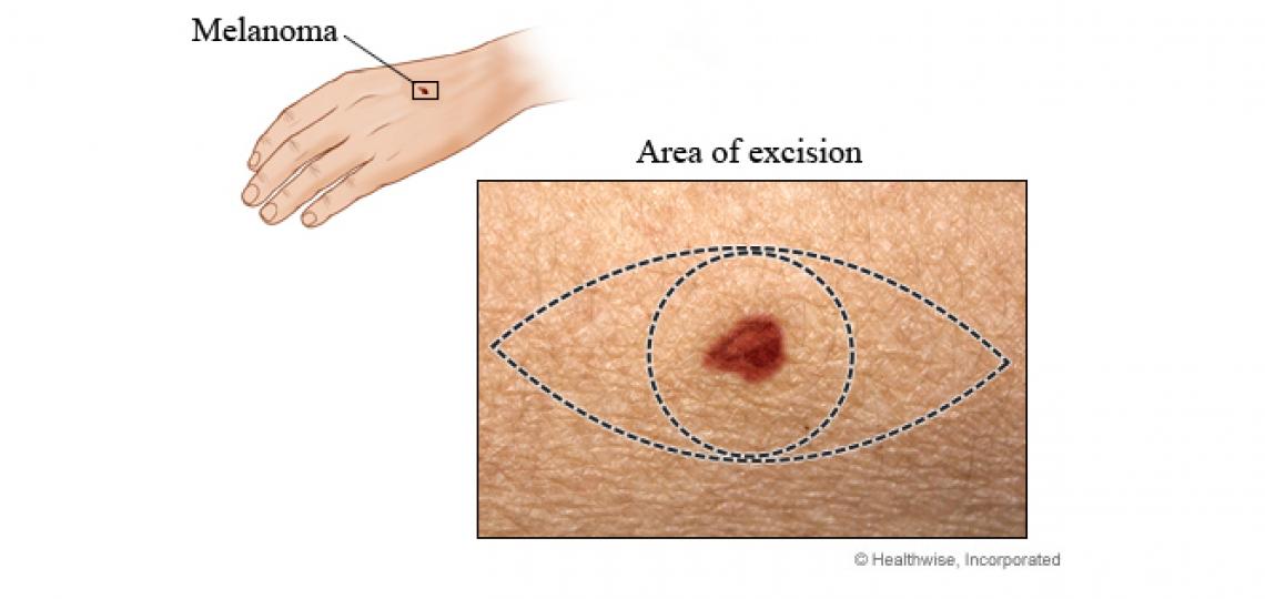 Wide Local Excision Dublin, IE, Lumpectomy Dublin