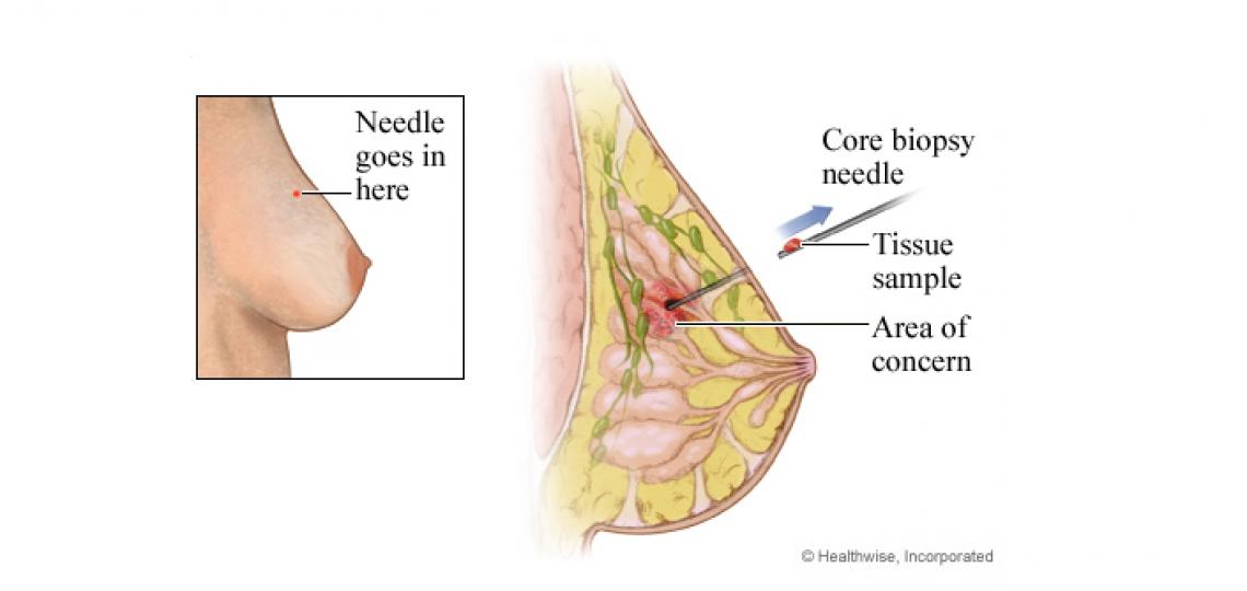 Locating Biopsy Marker Clips on Breast MRI: What a New Study Reveals