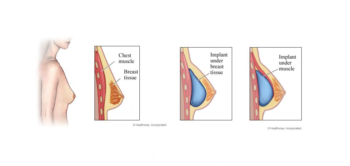 Breast Augmentation Implants Baylor Medicine