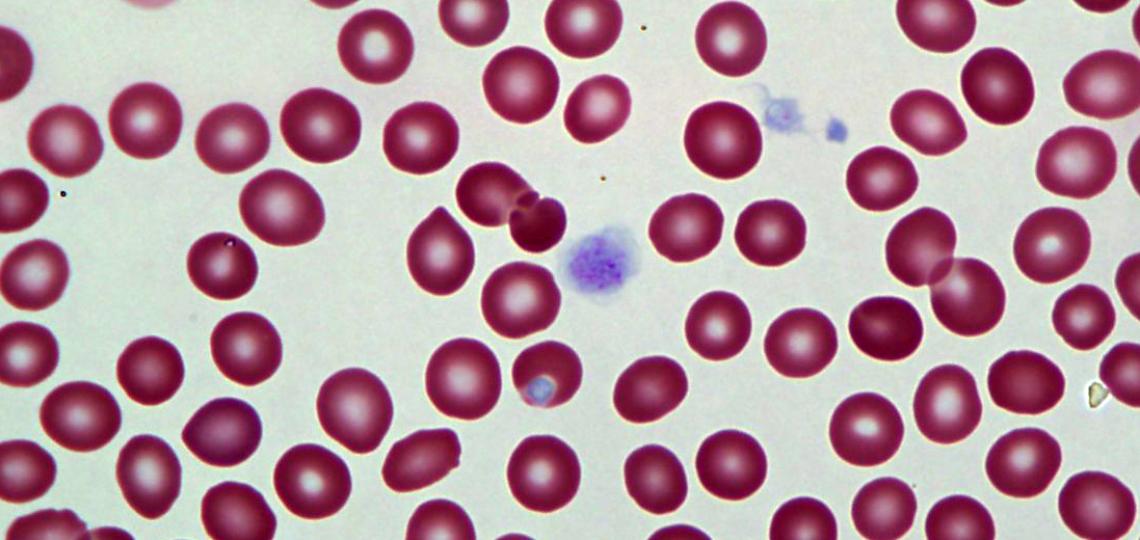 A blood smear sample showcasing giant platelets.