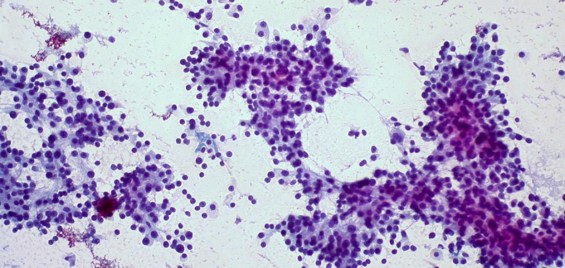 hepatocellularcarcinoma