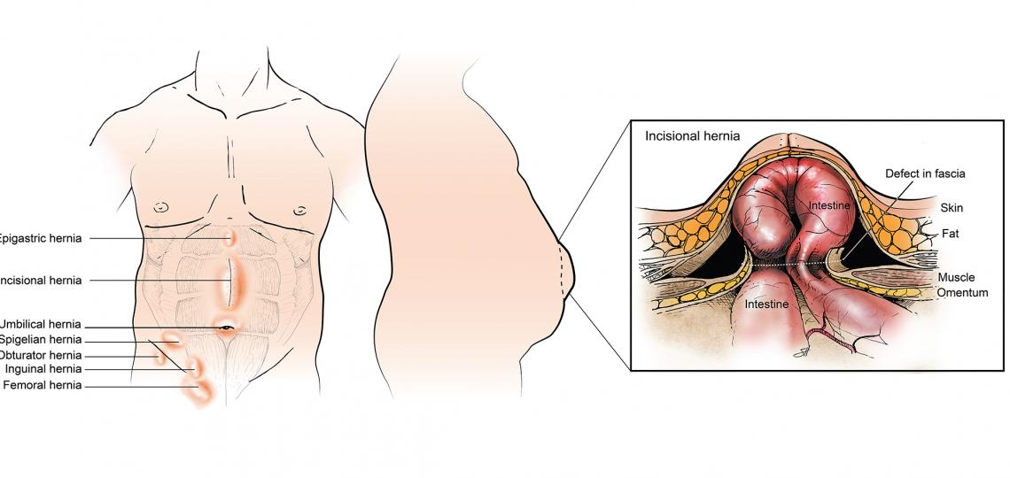 Hernia types and locations