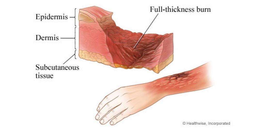 Assessment of burn degrees – PlastSurgeon