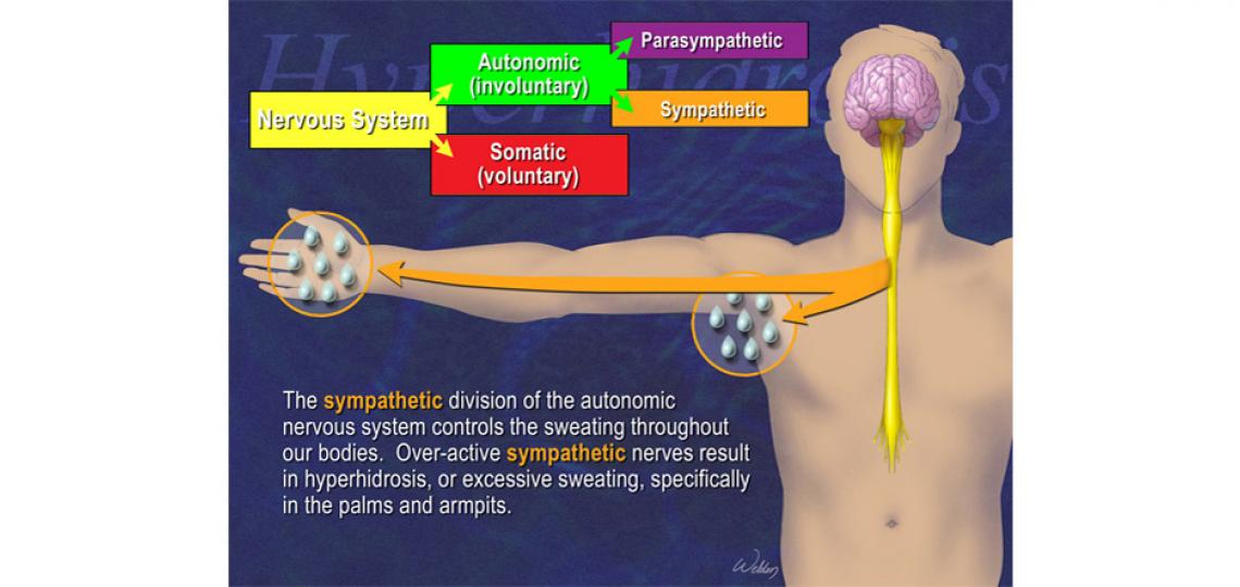 Sweaty Palms Hyperhidrosis Treatment