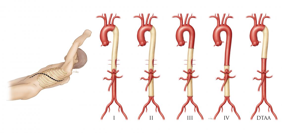 Incision site (left), and completed surgical repairs of thoracoabdominal aneurysm (right).