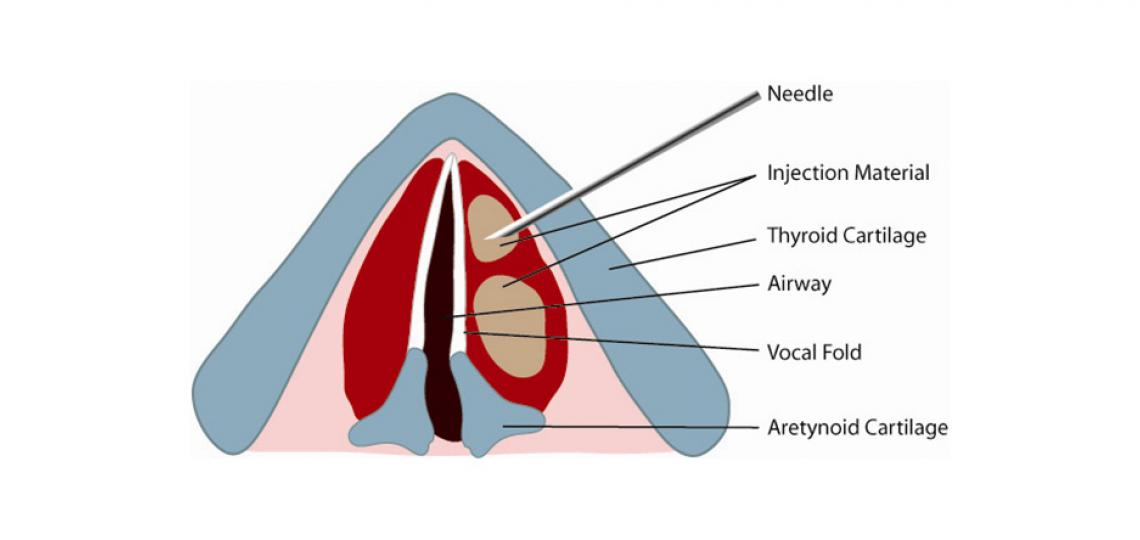Illustration of injection laryngoplasty (credit: Alexander Sevy, M.D.)
