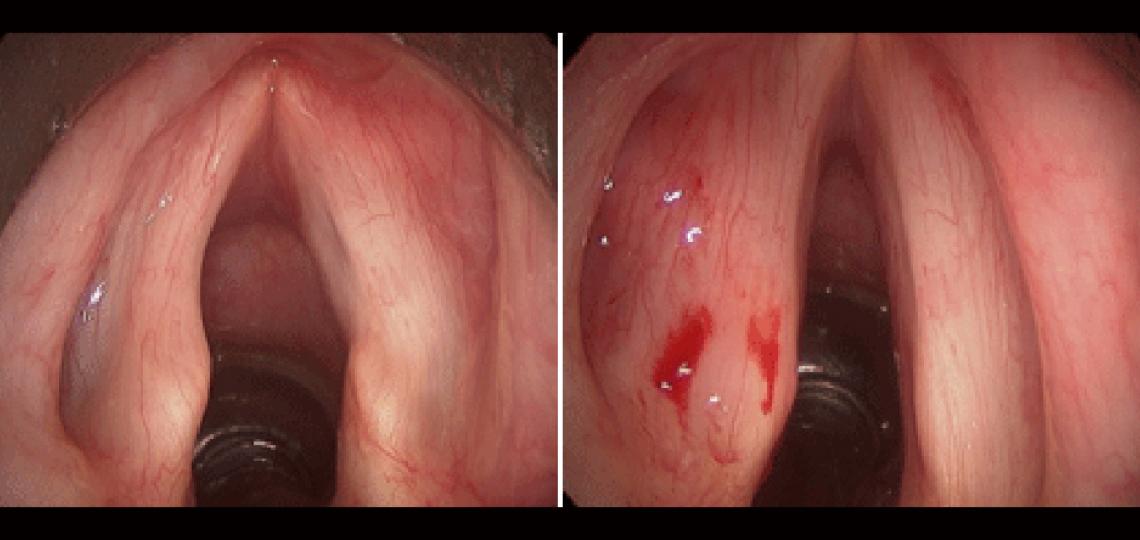 Before (left photo) and after (right photo) injection laryngoplasty