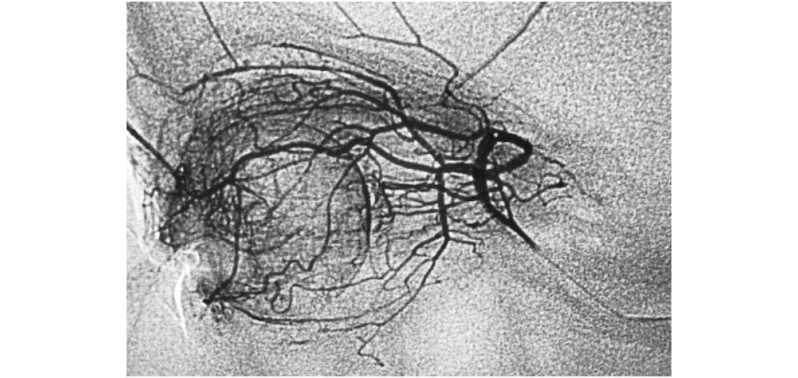 An ophthalmic angiogram obtained during selective chemotherapy infusion, demonstrates the extensive angioarchitecture that allows for concentrated regional local delivery of chemotherapy.