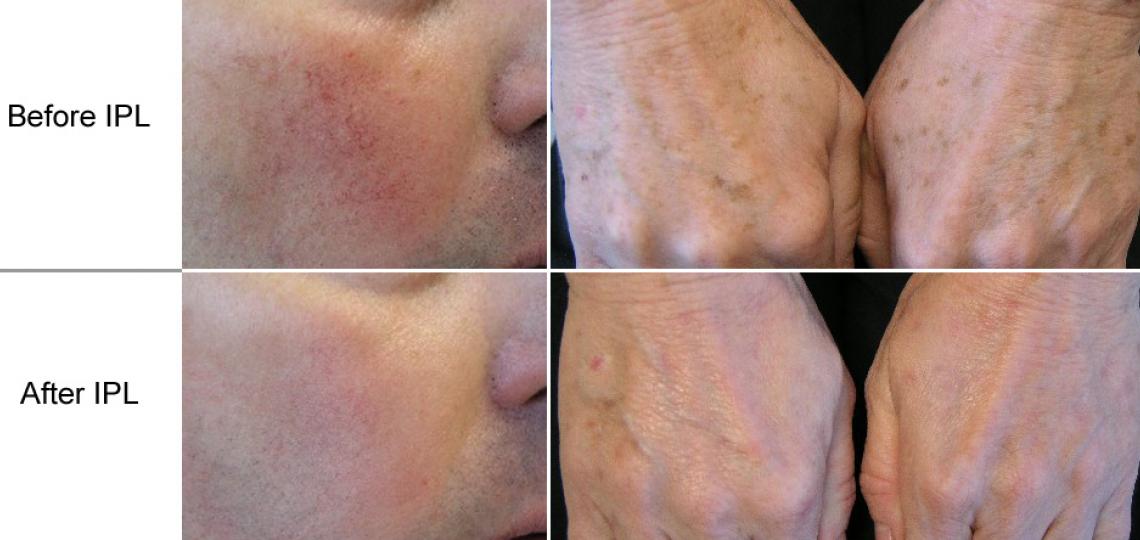 Left: A Baylor Dermatology patient shown below had 2 IPL treatments for facial blood vessels. Right: This patient had one treatment for brown spots on her hands.