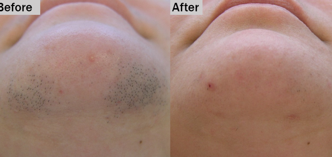 laser hair removal