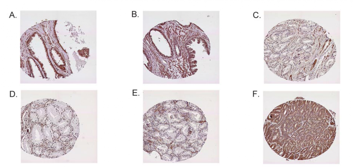Loss of expression of Sprouty1 protein in prostate cancer Loss of expression of Sprouty1 protein in prostate cancer.