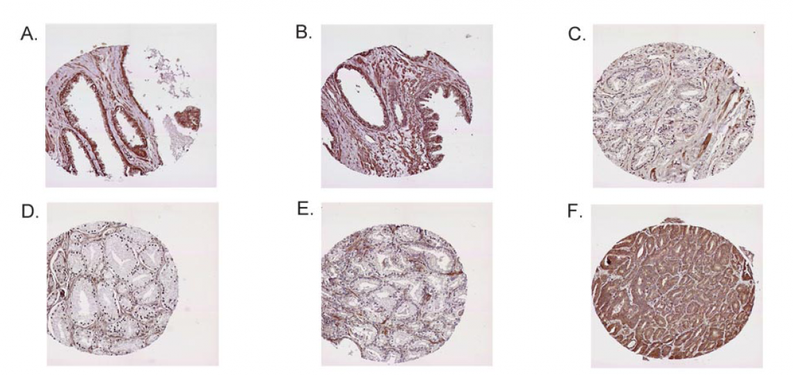 Loss of expression of Sprouty1 protein in prostate cancer.