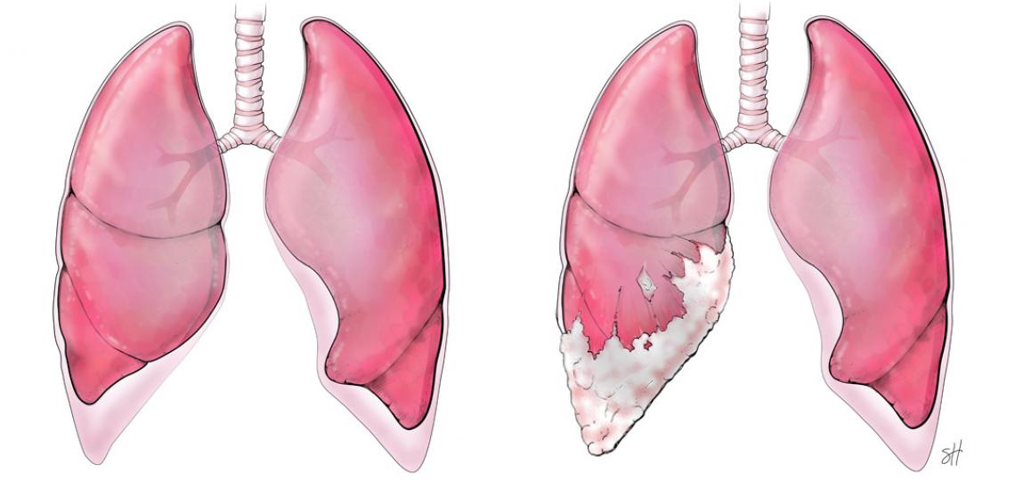 The illustration on the left shows a pair of healthy lungs. In the illustration on the right, the left lung is affected with malignant pleural mesothelioma, a cancerous tumor of the pleura. Illustration by Scott Holmes.