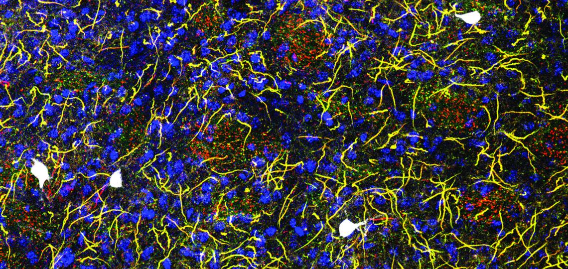 Blue: output cells. Yellow: nerve impulse trigger zones of output cells. White: Inhibitory neurons that hold back output. Red: trigger zones with a different type of ANK3 protein, lost in bipolar disorder and epilepsy.
