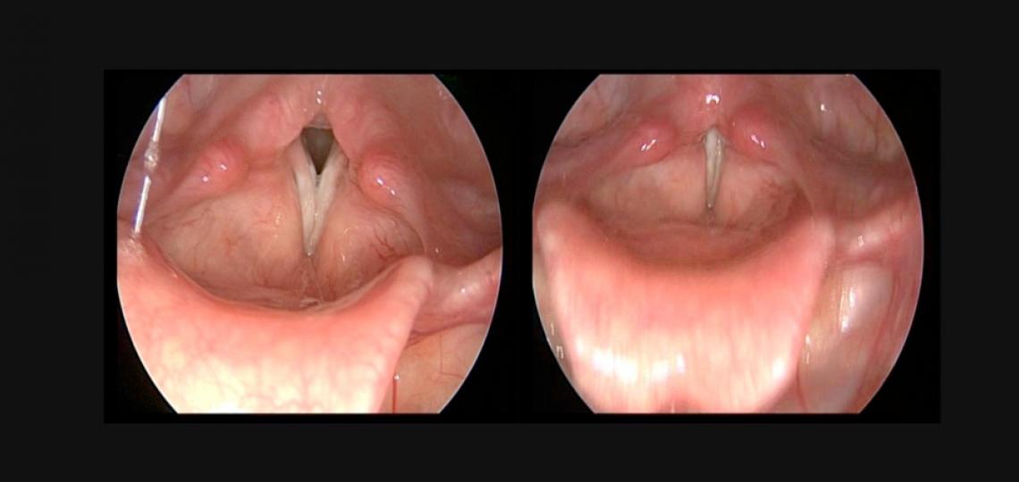 Paradoxical vocal fold movement. When the individual tries to breathe in, the larynx (voice box) does not open.