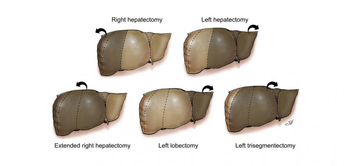 Common hepatectomy types showing resected portions (shaded with arrow). Illustration by Scott Holmes