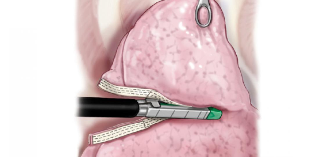 A portion of the upper lobe is resected using an endoscopic stapler with pericardial strips. Image courtesy McGraw-Hill Company.