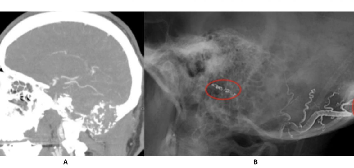 CT angiogram (A) reveals a large skull base tumor. Post embolization angiogram (B) shows liquid embolics (Onyx) in the feeding vessels supplying the tumor.