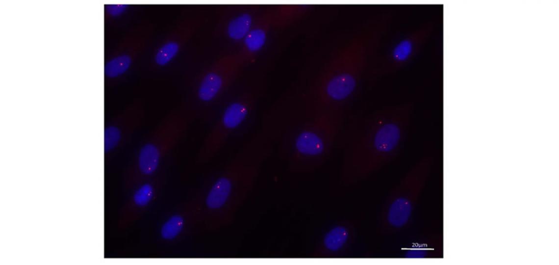 Fig. 1. RNA foci detected in immortalized DM1 cells by in situ hybridization.