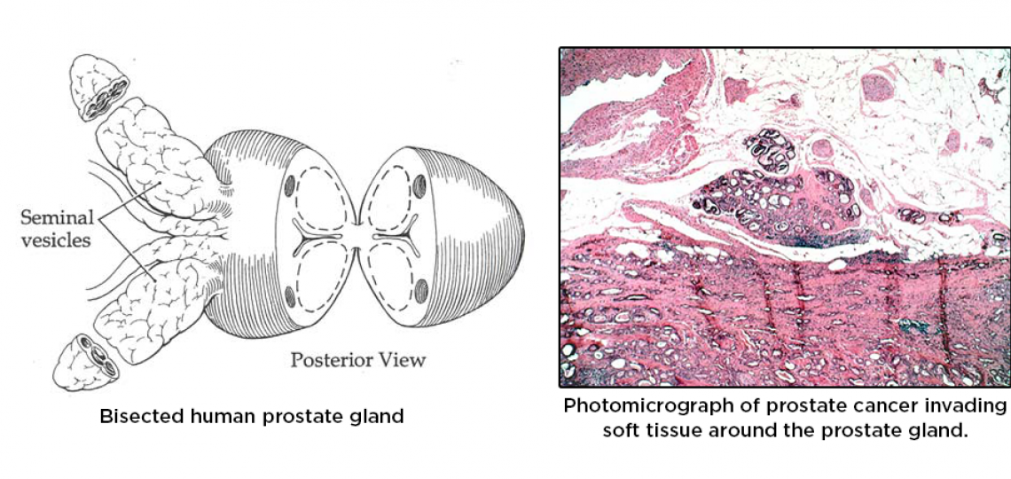Prostate Cancer overview.