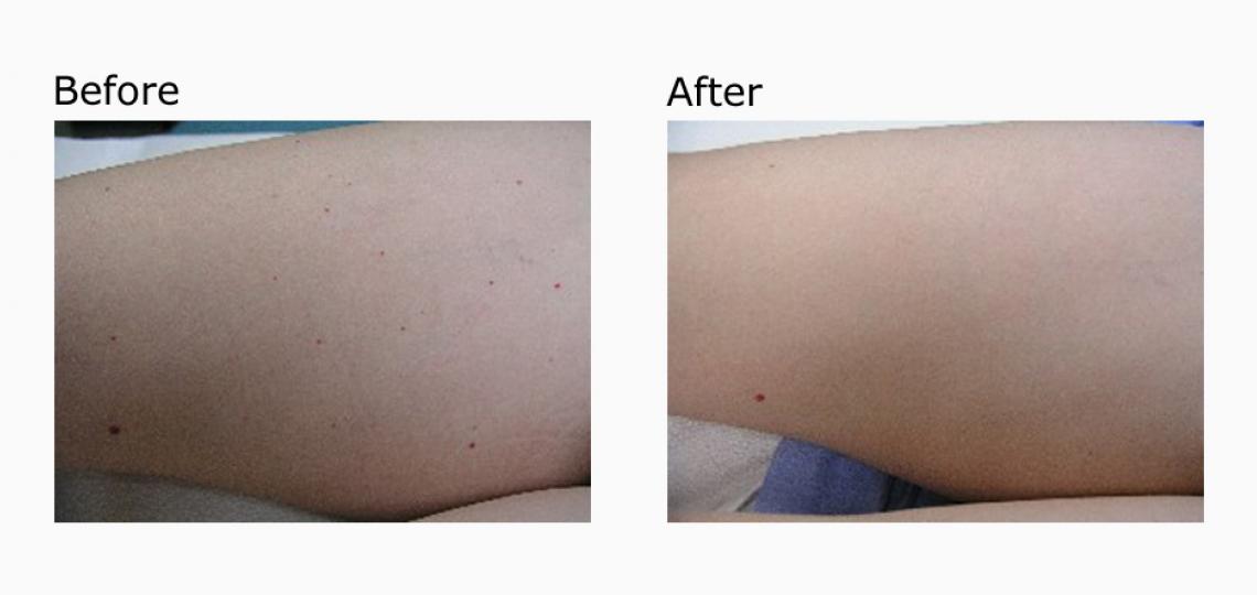 Above is a Baylor Dermatology patient had multiple cherry angiomas removed with one pulsed dye laser treatment.