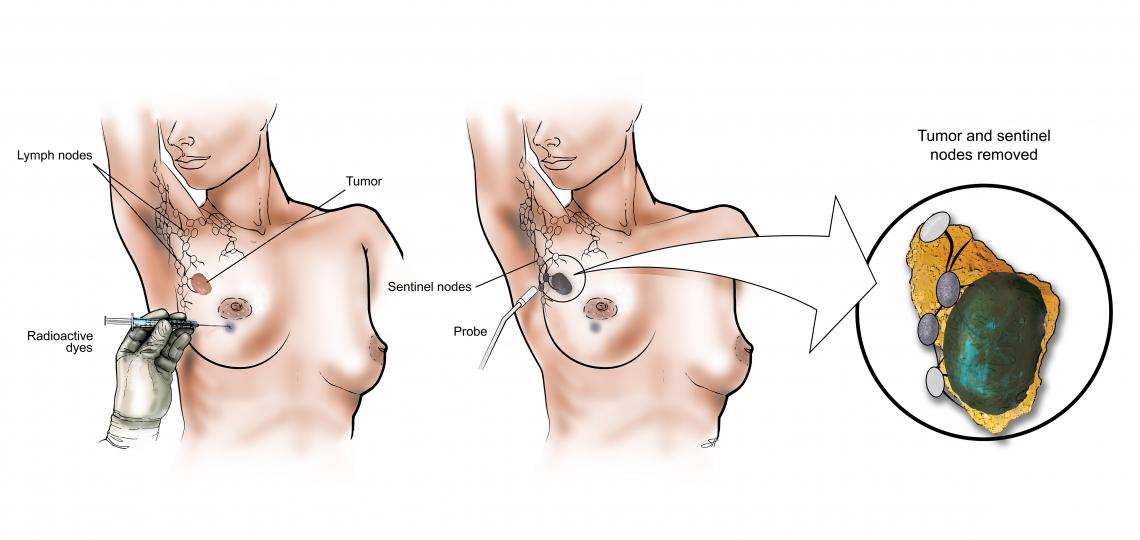 Lymph Node Surgery Baylor Medicine