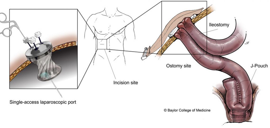 The single-access J-pouch procedure utilizes the same incision site for both the laparoscopic access port and the site of the ileostomy. Illustration by Scott Holmes