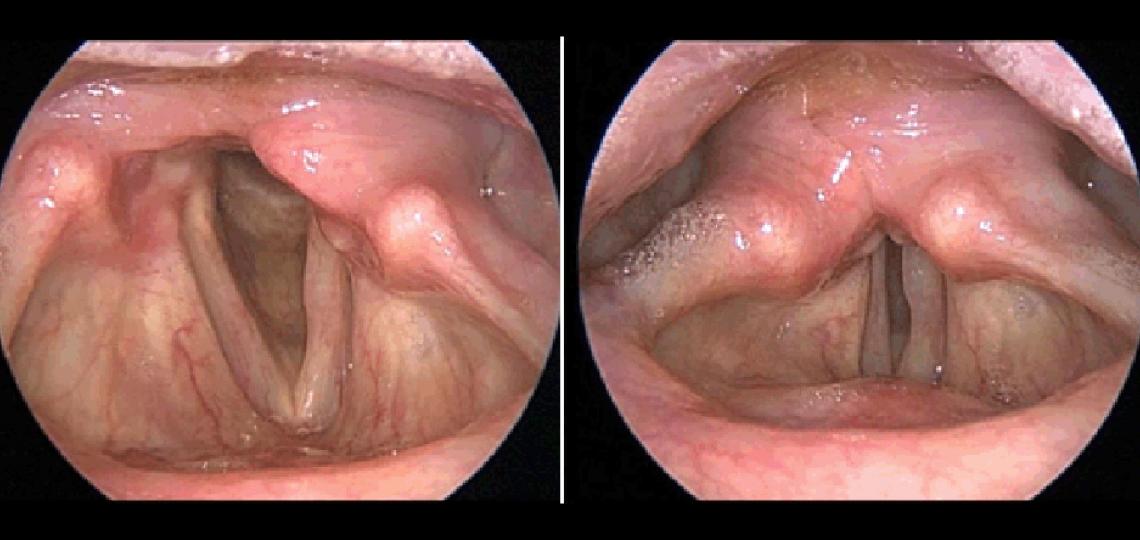 Unilateral (one-sided) vocal fold paralysis. Only one vocal fold is moving so when you try to talk there is a large gap between the vocal folds resulting in a weak, breathy voice.