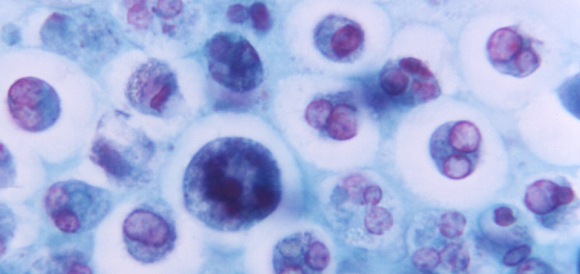 Magnified 1125X, this photomicrograph revealed the presence of a macrophage containing a number of phagocytized red blood cells (RBCs).