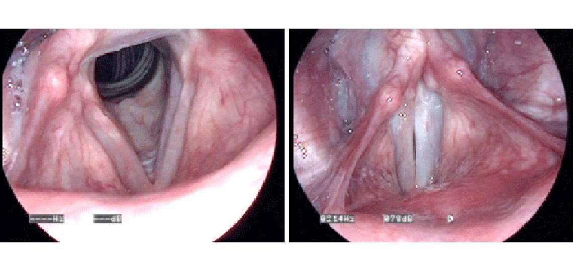 When you breath the vocal folds open (left photo). When you talk or swallow the vocal folds close (right photo).