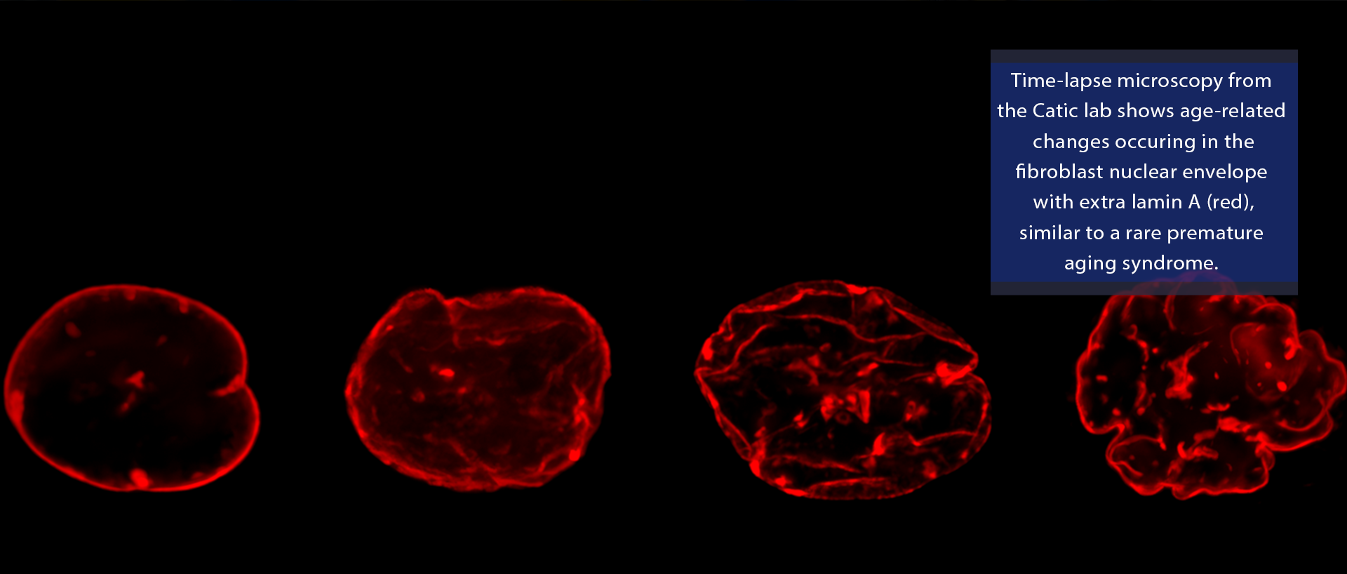 Time-lapse microscopy from the Catic lab shows age-related changes occuring in the fibroblast nuclear envelope with extra lamin A (red), similar to a rare premature aging syndrome. 