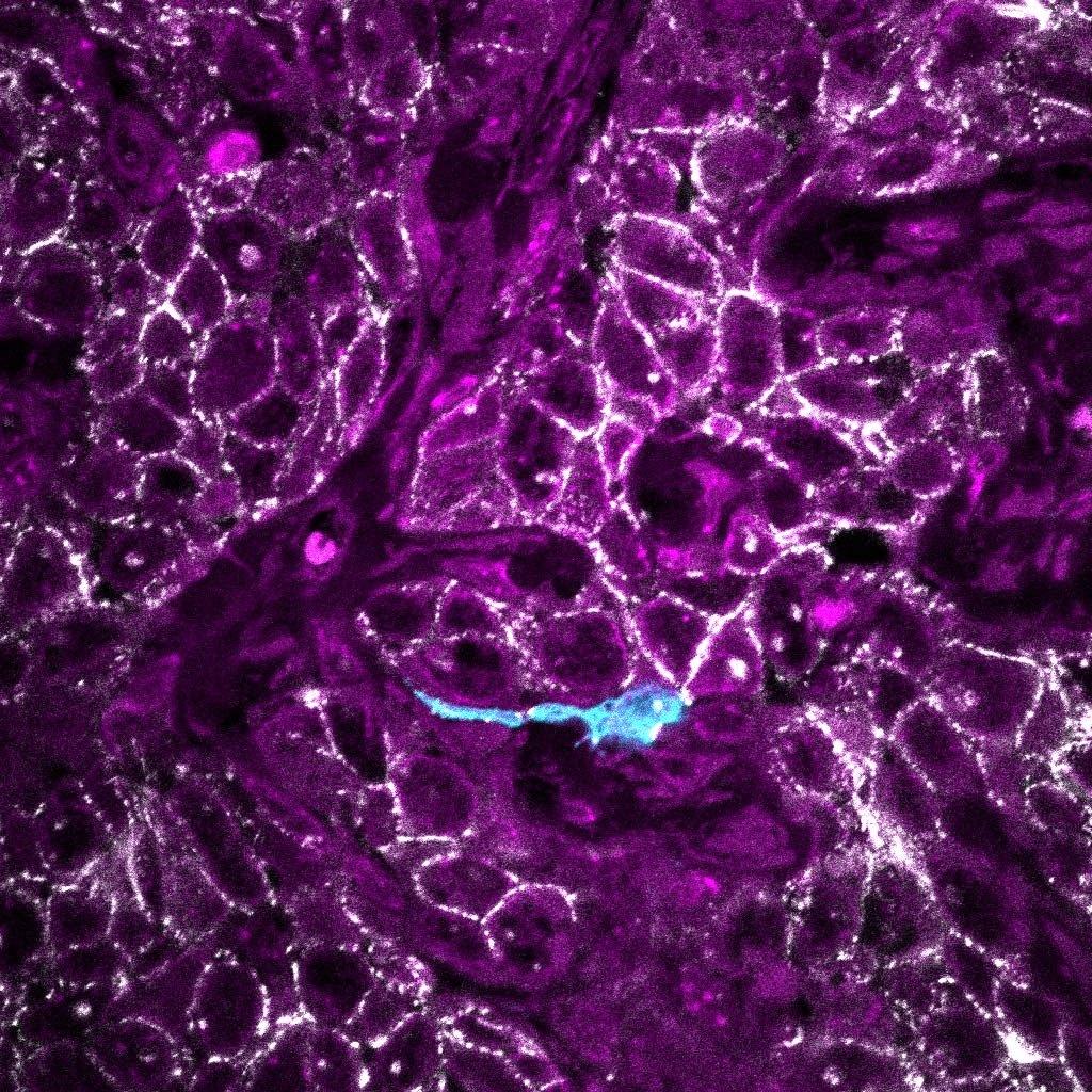 Fluorescent imaging of a Wnt-positive tumor cell (blue) migrating within the tumor landscape