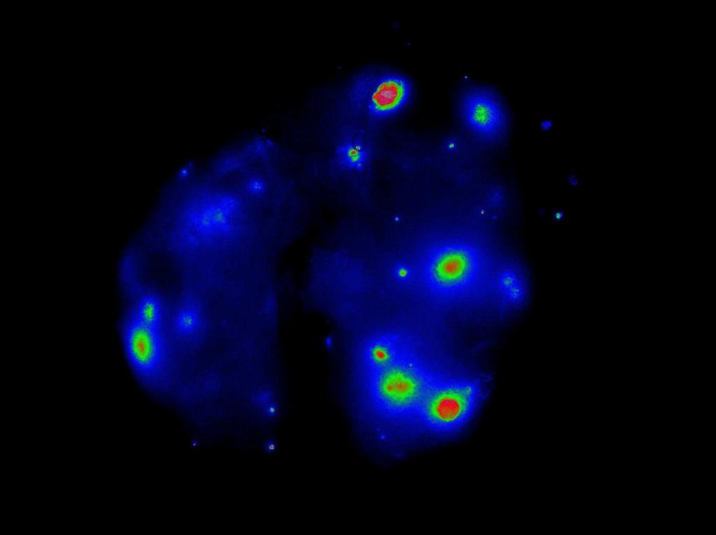 Lung metastases detected by fluorescence imaging