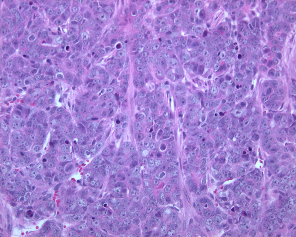 H&E staining of a TP53-null mammary tumor