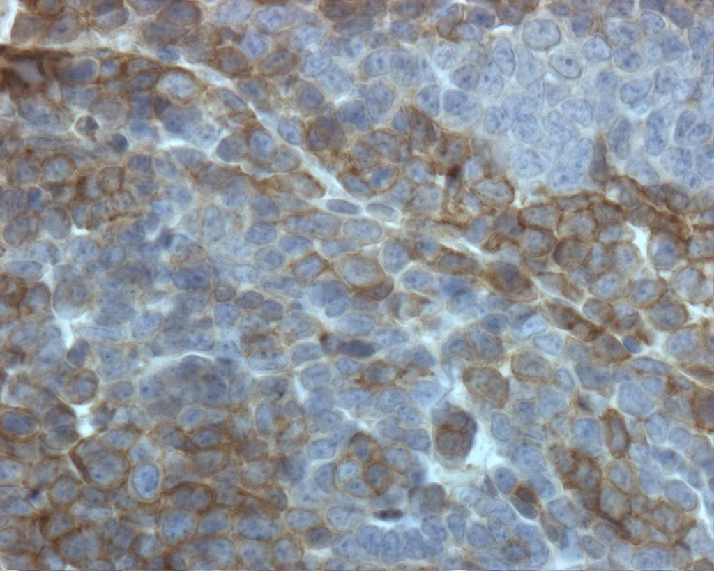 Wnt receptor expression within subpopulations of a breast cancer, detected by immunohistochemistry