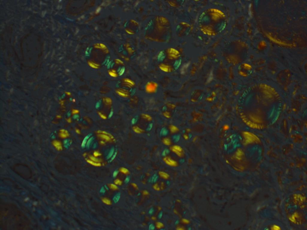 People's Choice Award - “The Beauty of Spheres”, Spheroid amyloid with polarized Congo Red stain