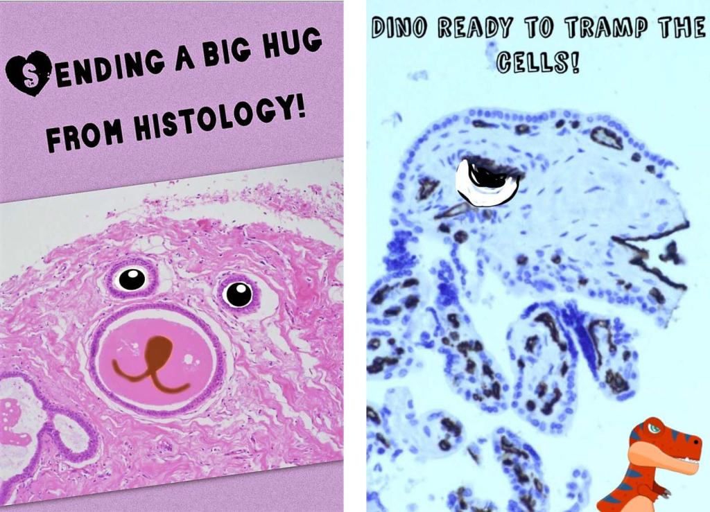 “Histology Hugs”, Benign breast with H&E stain; (right) “The Hungry Dinosaur”, Placenta with p57 stain
