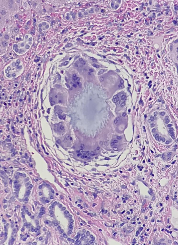 “Giant Flower”, Liver with H&E stain