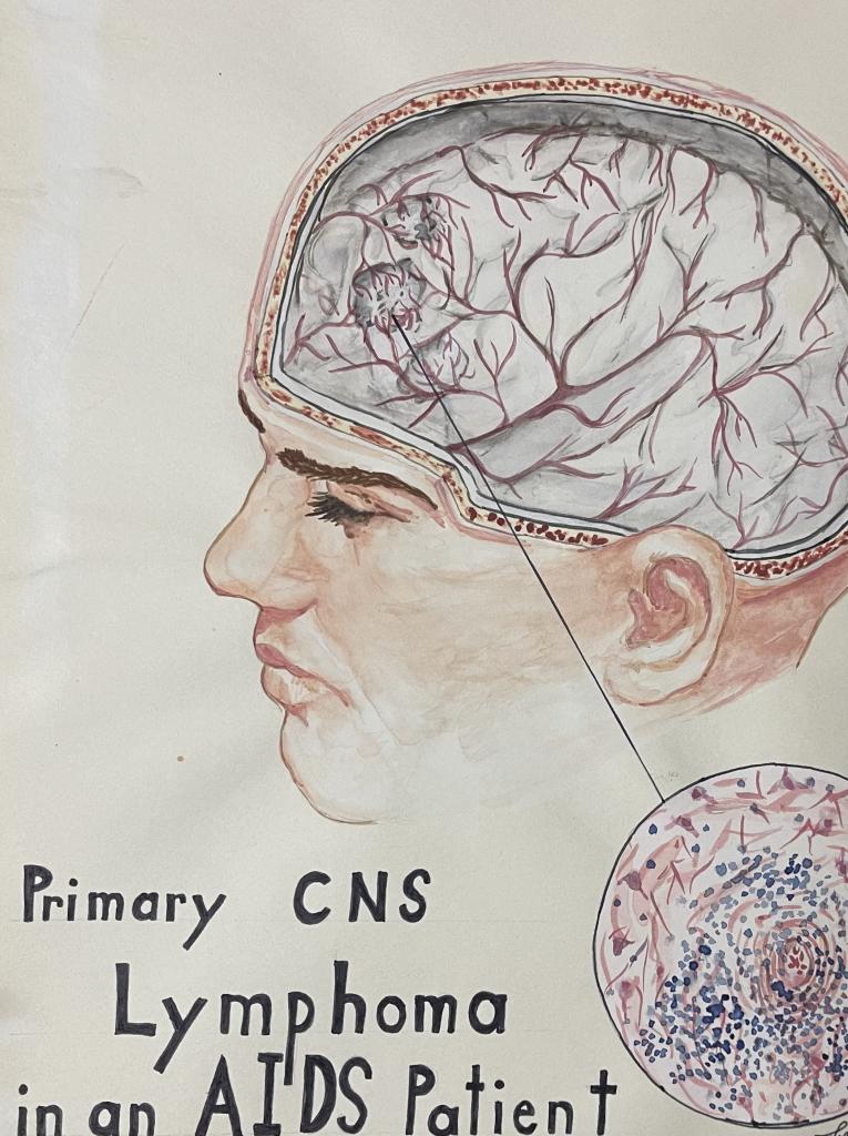 “Primary CNS lymphoma”, Water color