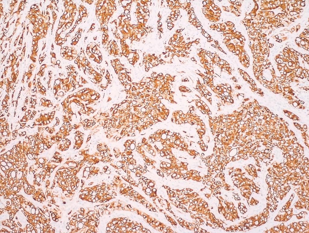 “Intrahepatic Bile Ducts: "I made these- for you!" Liver: "Those are cancer. You made cancer?”, Intrahepatic Cholangiocarcinoma Spinal Metastasis to Bone, CK7 immunohistochemical stain