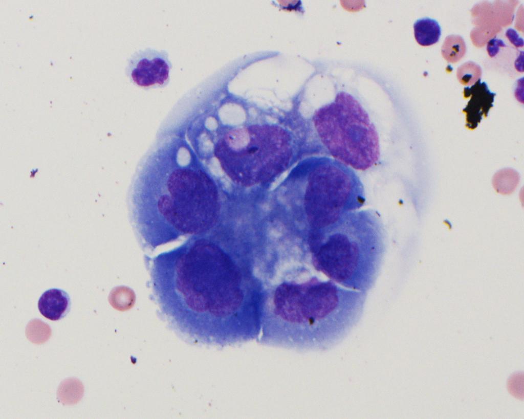 “Serous Flower”, Peritoneal fluid with serous endometrial carcinoma on Wright’s stain