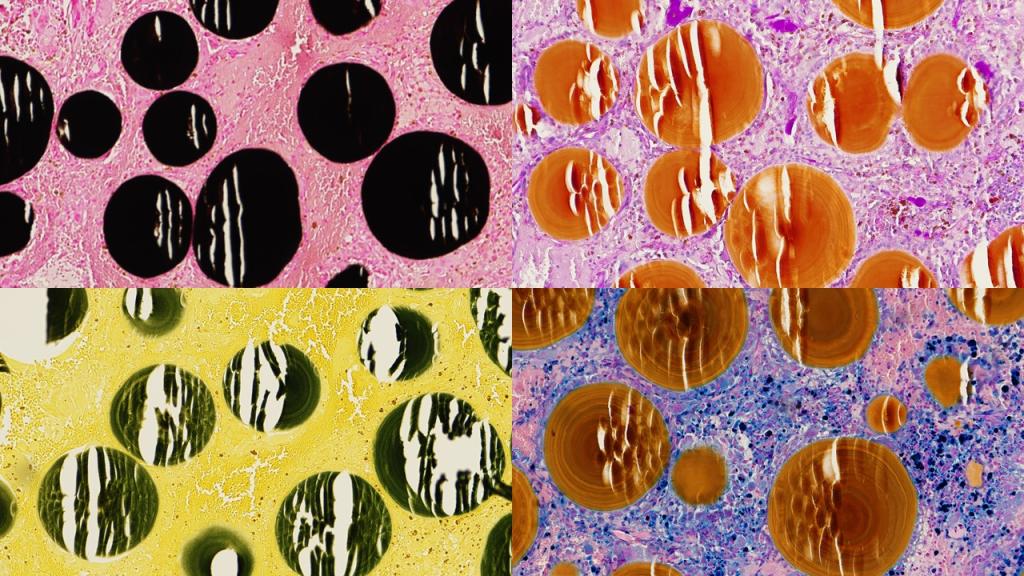 “Crystallized bilirubin deposition in bone”, Top left: Von Kossa, Top right: PAS, bottom left: bile stain, bottom right: Iron.
