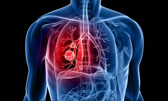 A graphical illustration of lung cancer.