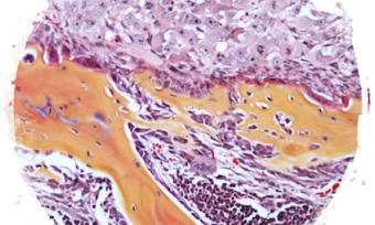 Breast cancer cells (top part) within the bone