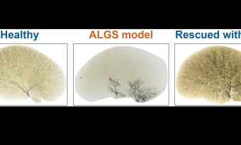 Shown are biliary tree ink injection images from the left liver lobes of 30-day-old mice. Note the improvement in the density and peripheral extension of the biliary tree in Alagille syndrome (ALGS) model upon AAV-mediated gene therapy. From Fox et al, Gastroenterology.