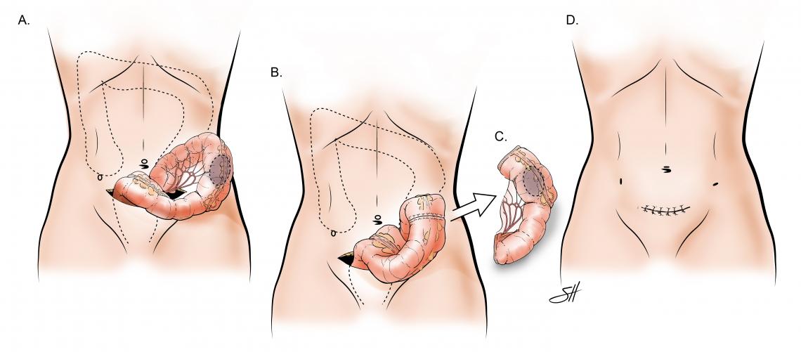 Colorectal Surgery with Transanal Excision Baylor Medicine