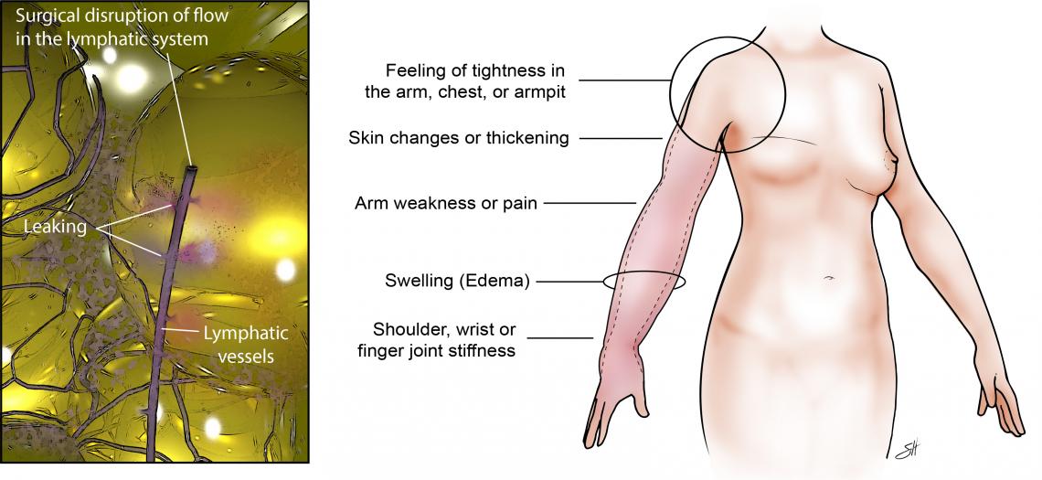 Lymphedema Surgery Baylor Medicine