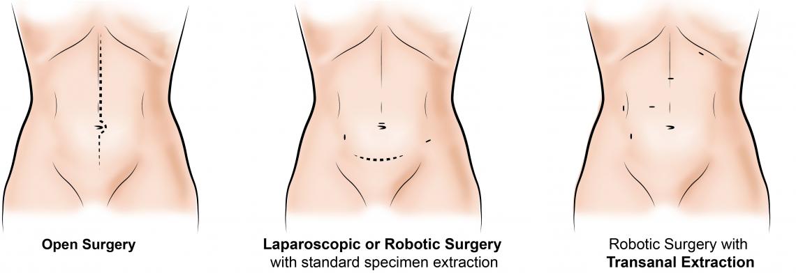 Colorectal Surgery with Transanal Excision Baylor Medicine