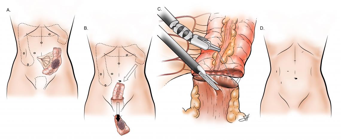 Colorectal Surgery with Transanal Excision Baylor Medicine